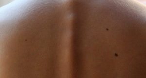 Nei pericolosi: come riconoscerli e asportarli Come rimuovere i nei maligni