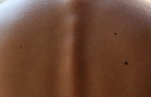 Nei pericolosi: come riconoscerli e asportarli Come rimuovere i nei maligni