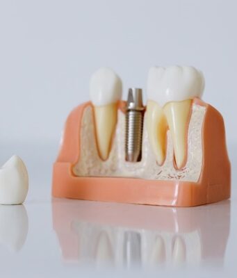 Come scegliere il dentista giusto per un intervento di implantologia Intervento implantologia dentale