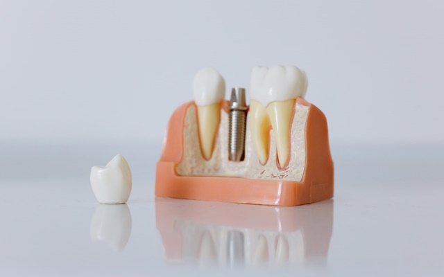 Intervento implantologia dentale